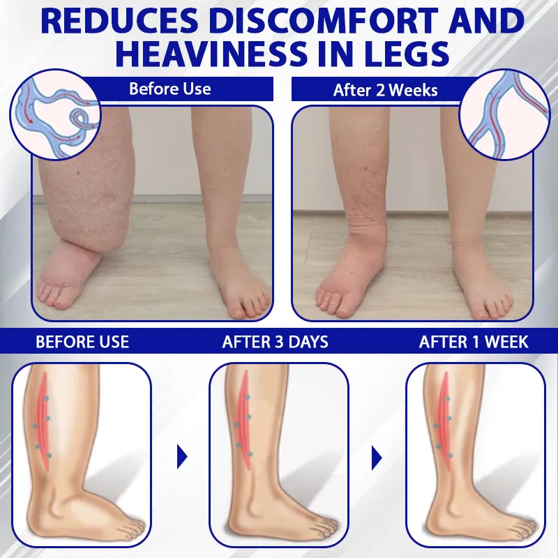 Tired, Swollen, or Heavy Legs? NESLEMY™ Restores Freedom of Movement!